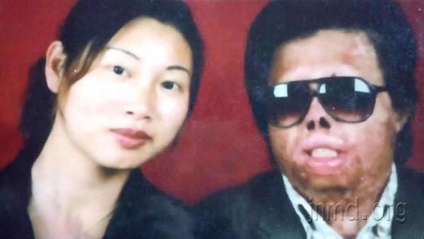 毁容残疾之后，神的爱点